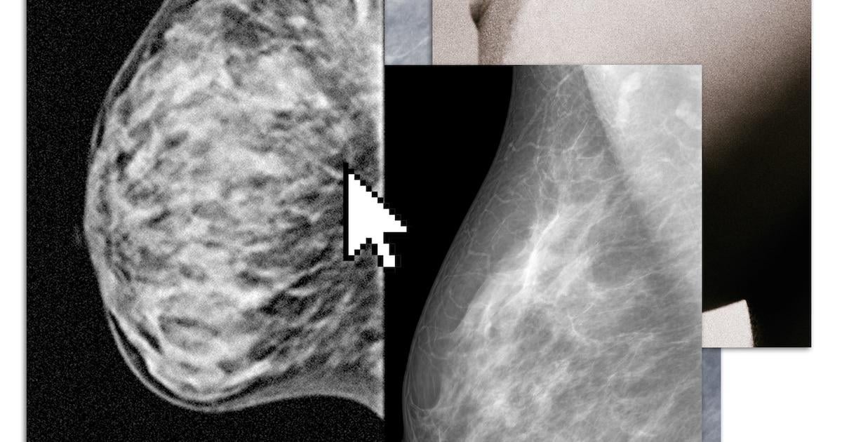 De MRI om tumoren op te sporen bij hoge borstdichtheid is er nog niet. Dus zoeken vrouwen zelf naar screening