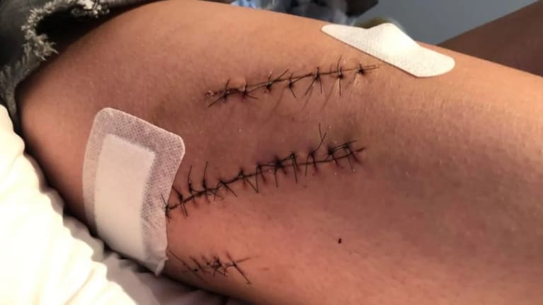 One of the victim's injuries.