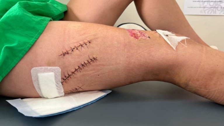 The propeller strike left serious injuries.