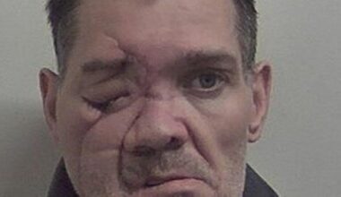 Severely injured burglar 'discharges himself' from hospital to commit more crimes