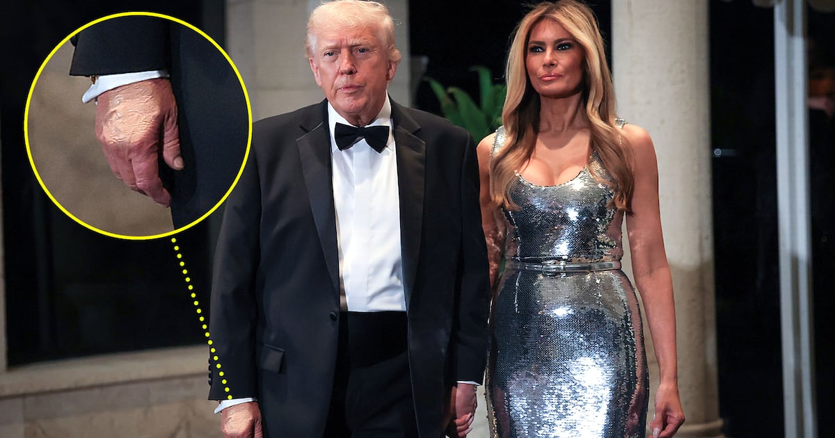 Trump, 79, Rings In The New Year With Makeup-Covered Hand