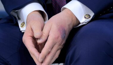 Trump bruises hand at Davos World Economic Forum signing ceremony