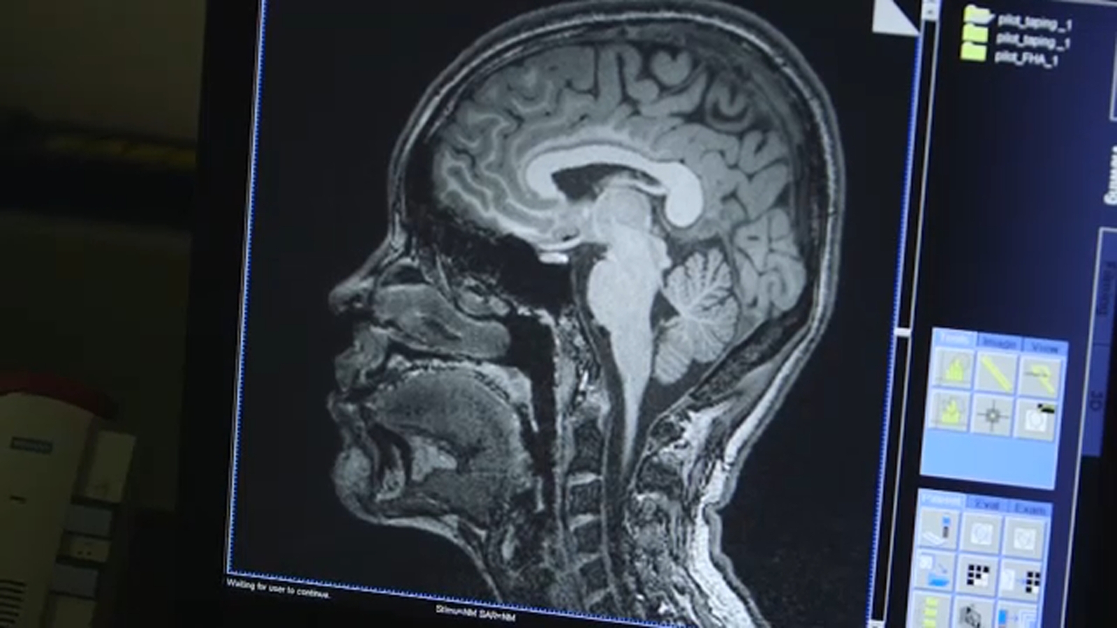 New UCLA AI tool targets Alzheimer's cases often missed in early diagnosis