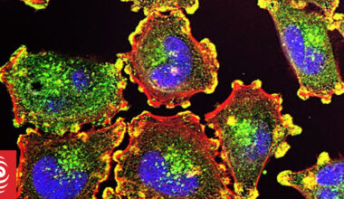Auckland scientists hope to develop melanoma treatments with million-dollar boost