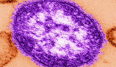 6 European countries, including UK and Spain, lose measles elimination status