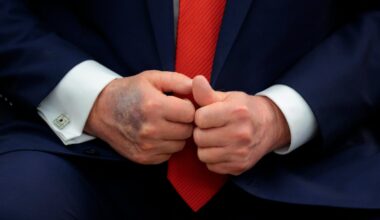 President Trump's bruised right hand at the White House last year. His press secretary called it a result of "constantly working and shaking hands all day every day."