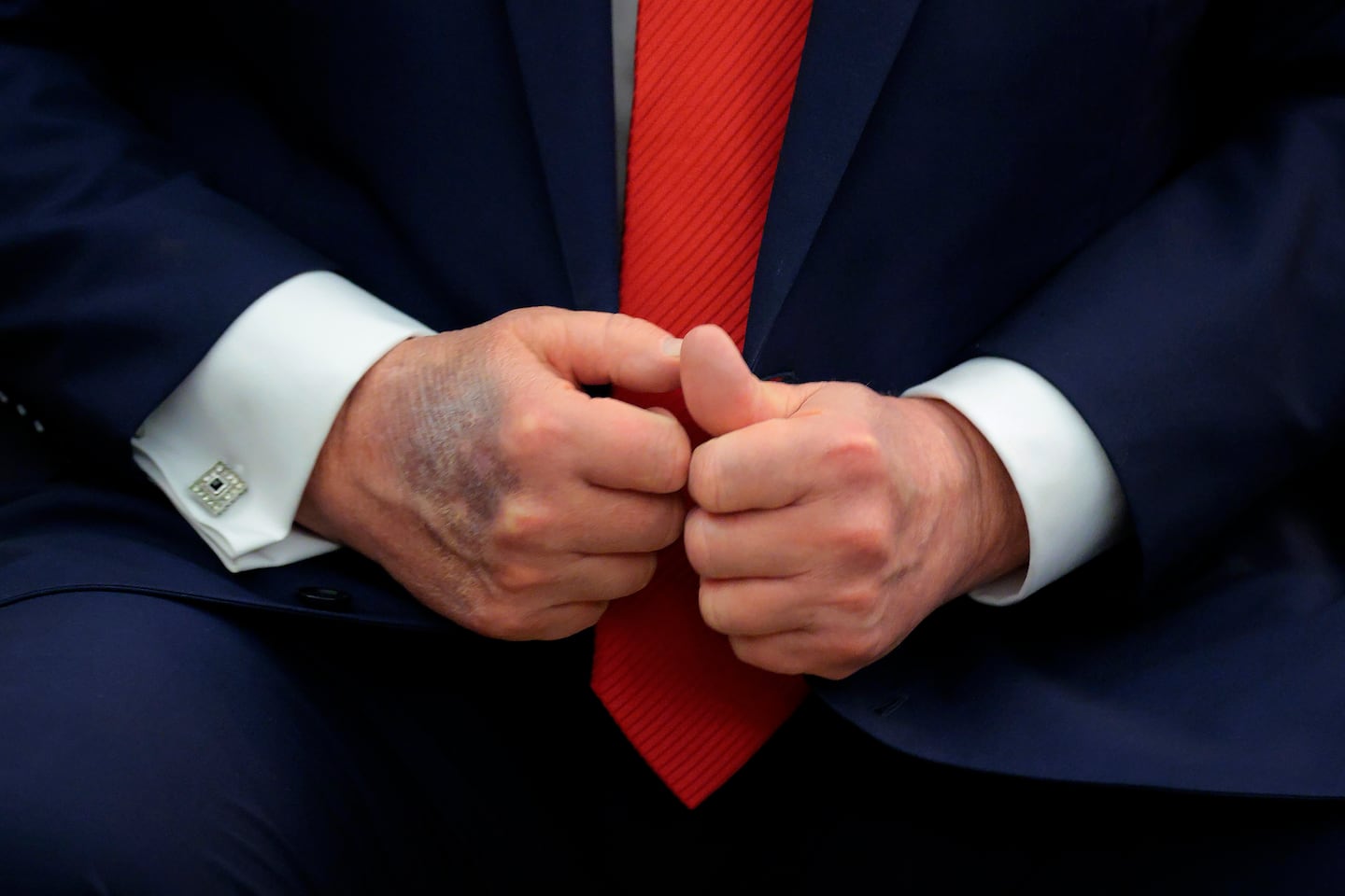 President Trump's bruised right hand at the White House last year. His press secretary called it a result of "constantly working and shaking hands all day every day."