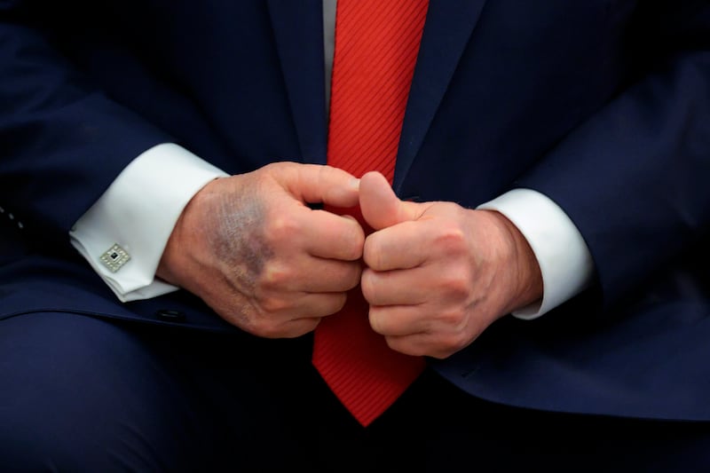 A bruise is visible on the back of U.S. President Donald Trump's right hand on August 25, 2025 in Washington, DC.