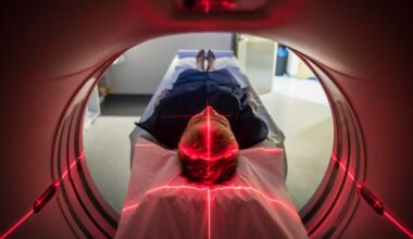 Menopause Linked to Gray Matter Loss in the Brain