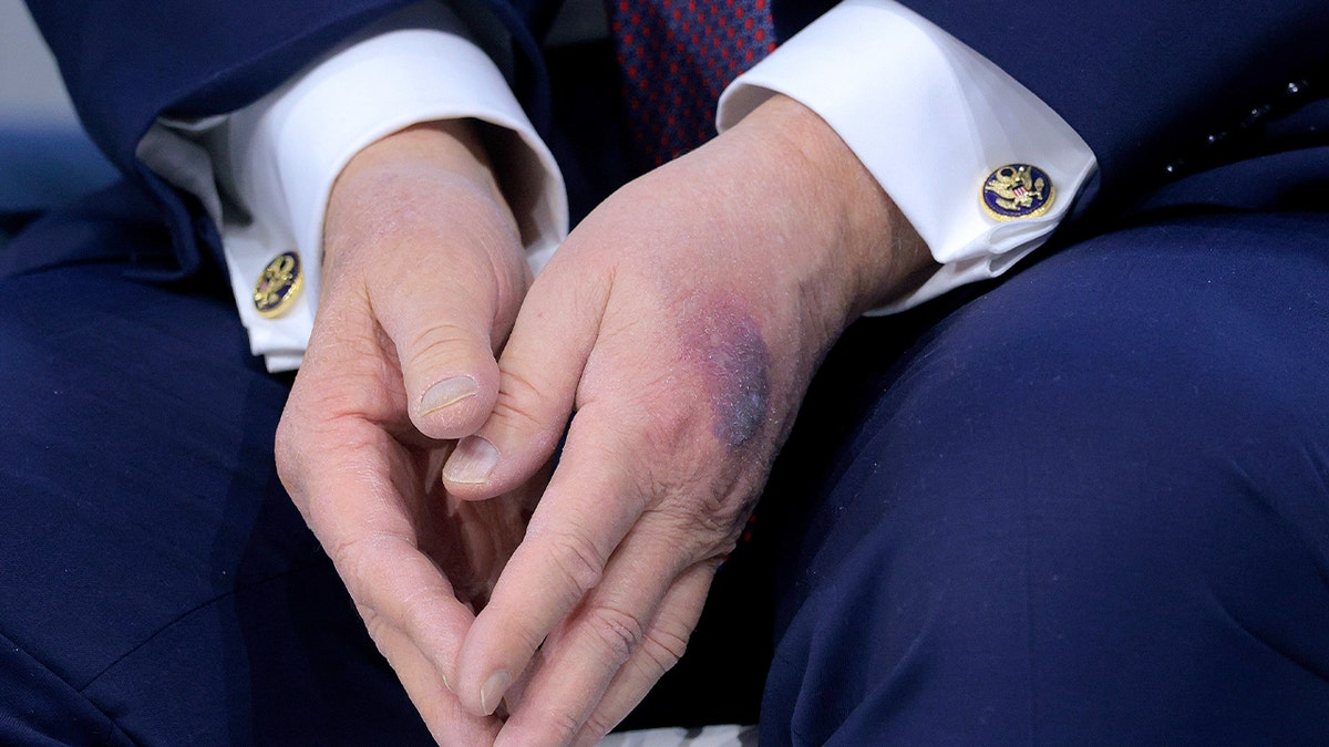 A close view shows a bruise on the back of the U.S. president’s hand during a formal signing event.