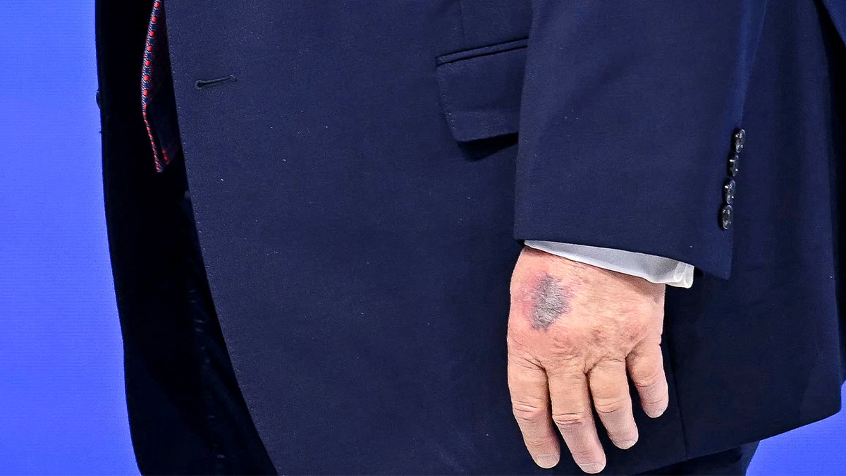 A close-up view shows a mark on the U.S. president’s hand as he walks through a conference venue.