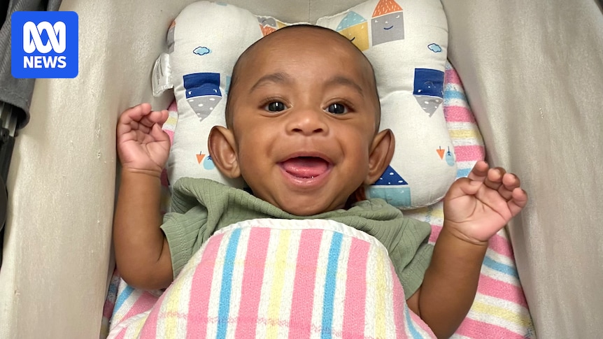 The race to save a conjoined twin