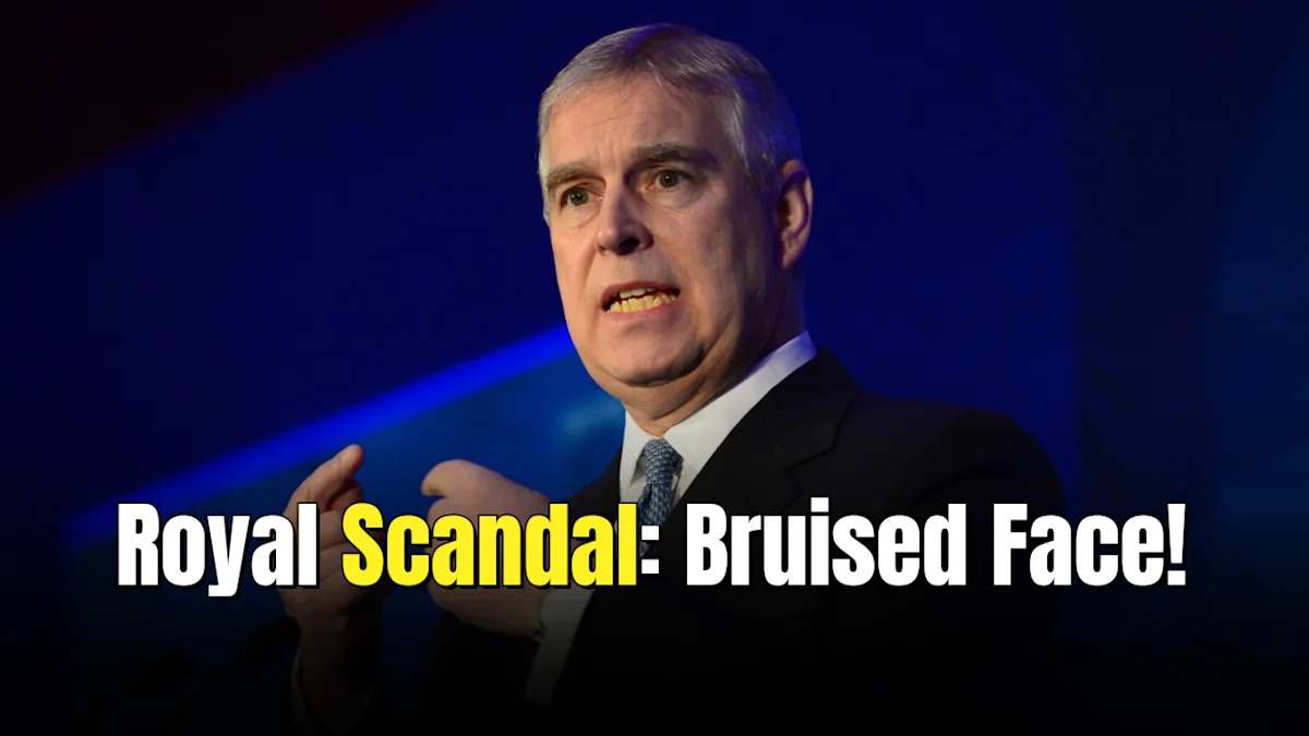 Former Prince Andrew Spotted With Massive Facial Bruise Days After New Assault Claims