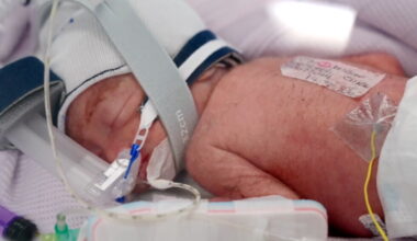Australian woman gives birth to identical quadruplet girls